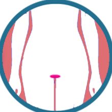 Vulvar cancer surgeon in Delhi